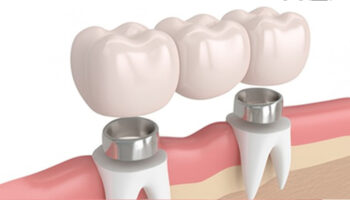 Do You Need a Dental Crown? Signs to Look For