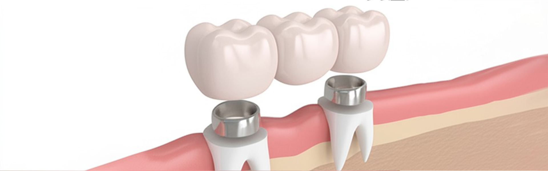 Do You Need a Dental Crown? Signs to Look For